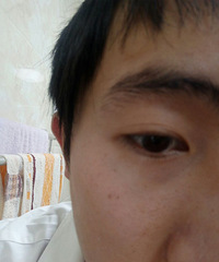 眼皮褶皱