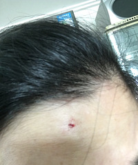 额头撞到桌角尖锐处,会留疤吗?