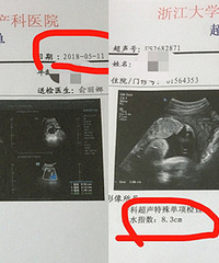 吓坏!多喝水!不喝水羊水会被反吸收?