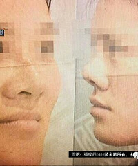 花了五万一,变成“跟猪一样的鼻子”……被同事嘲笑,还丢了工作