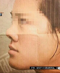 花了五万一,变成“跟猪一样的鼻子”……被同事嘲笑,还丢了工作
