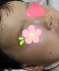 玩耍时女童将竹签插入口中