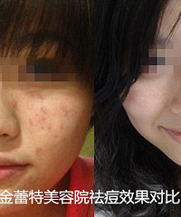 脸上老是长痘痘怎么办?内因外显,这么调理才可以
