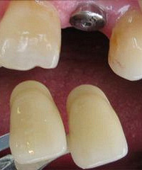 将人工牙根植入患者缺牙处的牙槽组织,待人工牙根愈合以后,再在种植体