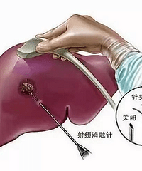 25岁肝癌四年复发,男孩前来求助中医