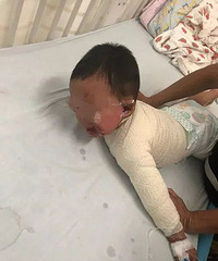 杭州一男婴被100℃洗澡水烫伤!妈妈的急救动作被医生点赞