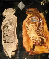 没事多健健身,给医生创造方便,就等同于在救自己的命啊!