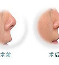 朝天鼻矫正手术有哪几种方法?