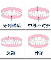 杭州美奥口腔浅谈儿童整牙要多少钱?