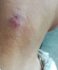 这个皮肤病怎么治,求指点!