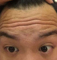 抬头纹多的人注意了!你比同龄人更可能死于心血管疾病!