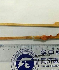 可怕!竹签扎穿2岁宝宝的肺部 离心脏血管很近了