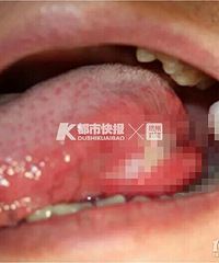 杭州29岁小伙口腔溃疡两个月不见好,一查竟是癌?
