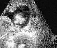 ���ţ�����ʱ���ֱ�����Ƥ���г��ѿ�,���Ӷ�¶����ˮ����