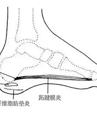 跟骨滑囊炎的治疗方法