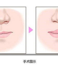 唇部手术是永久的吗?会不会反弹及其他后遗症?