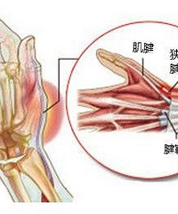 腱鞘炎的治疗偏方