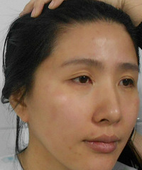 成都自体脂肪面部填充效果分享