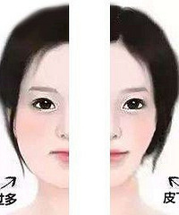 成都自体脂肪面部填充效果如何