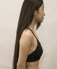 成都自体脂肪隆胸术后90天案例分享