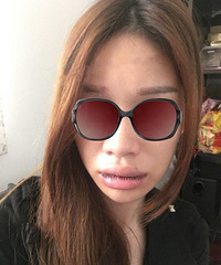 成都厚唇改薄术后怎么护理好