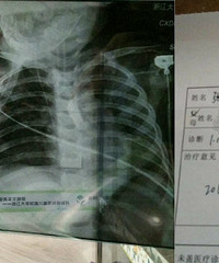 求助!18个月的孩子只能靠呼吸机续命