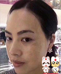 满脸雀斑还能嫁给高富帅,“斑花”教你祛斑