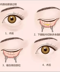 成都去眼袋手术,去眼袋手术后,应该冰敷吗?
