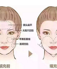成都自体脂肪面部填充的优势有哪些?
