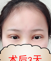 �������ڳɶ���˫��Ƥ�Ļָ����̼�����