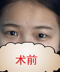 分享我在成都做双眼皮的恢复过程及经历