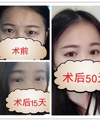成都割双眼皮,刘晶,双眼皮手术有哪些类型