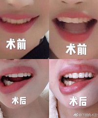 25岁女孩整容成歪嘴:毁了我一生!医院只赔5000元