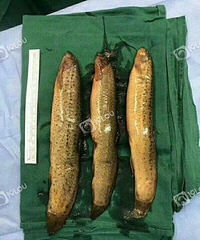在医生的朋友圈,你总能看到奇葩的病例……3条大泥鳅从那里进去
