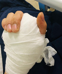23岁小伙拧螺丝挤出水泡 没想到竟然最后截指了