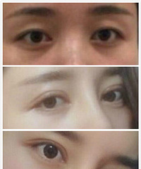 成都很多美女问割双眼皮疼不疼?刘晶医生告诉大家