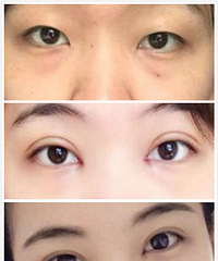 成都整形医生刘晶介绍:割双眼皮后遗症有什么?