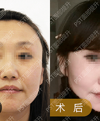北京面部提升医生,李晓东教授介绍pst面部提升