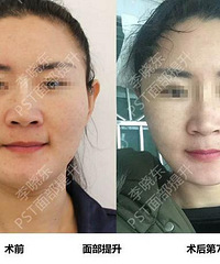 李晓东PST面部提升专家顾客的一封信