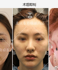 北京做面部提升哪里好?李晓东教授