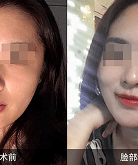 李晓东微创面部提升除皱术的优势