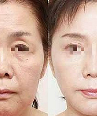 李晓东面部提升和线雕的区别?