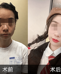 北京李晓东教授,pst面部提升与其他提升方法的区别?
