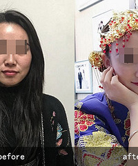 北京李晓东面部提升专家介绍面部提升的三大特点是什么