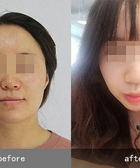 苏州做埋线提升哪位医生专业,李晓东教授pst专利技术