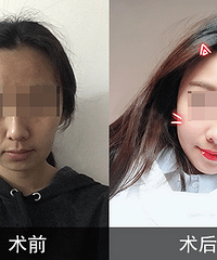 杭州做面部埋线提升,北京李晓东怎么样 靠谱吗