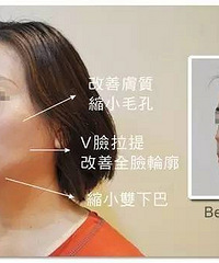 李晓东pst面部提升,有效解决面部松弛问题!