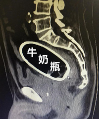 这么大的牛奶瓶怎么会塞进体内?医生:这题超纲了…