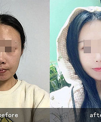李晓东面部提升术,为什么面部提升手术可以使皮肤更加紧致?