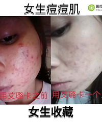 【有图有真相】太太太太厉害了艾璐卡能修复痘痘肌